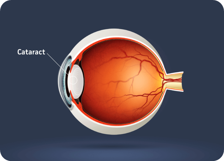 eyeplus cataract